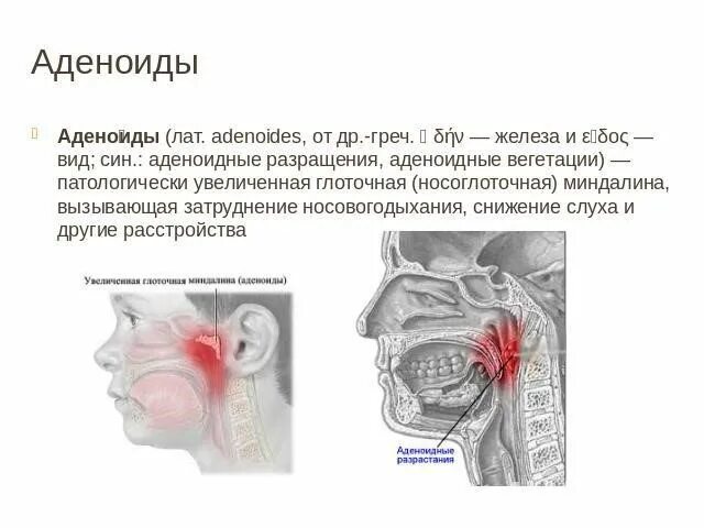 Аденоиды 2 степени аденоидит. Аденоиды вегетации 3 степени. Аденоиды 1-3 степень у ребенка. Гипертрофия аденоиды 3 степени. Вегетация у детей