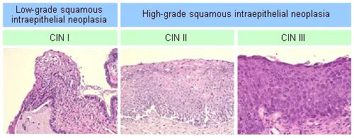 Grade 4 в онкологии что это. High grade в онкологии. Low grade в онкологии. Cambridge c1. Grading (tumors).