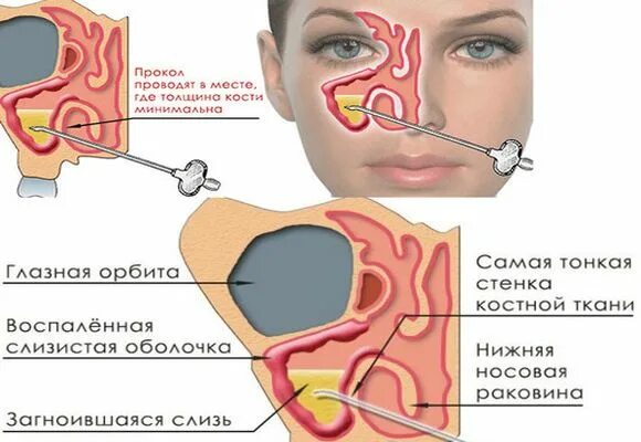 Гайморит сам проходит. Острый гайморит пункция. прокол гайморовой пазухи.