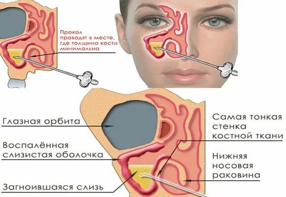 После прокола гайморовой. Прокол (пункция) гайморовой пазухи. Прокол гайморовой пазухи.