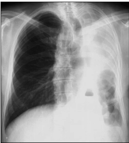 уплотнение аорты на флюорографии. дуга аорты на флюорографии. аорта на снимке флюорографии. уплотнение аорты на флюорографии. уплотнение аорты на флюорографии.