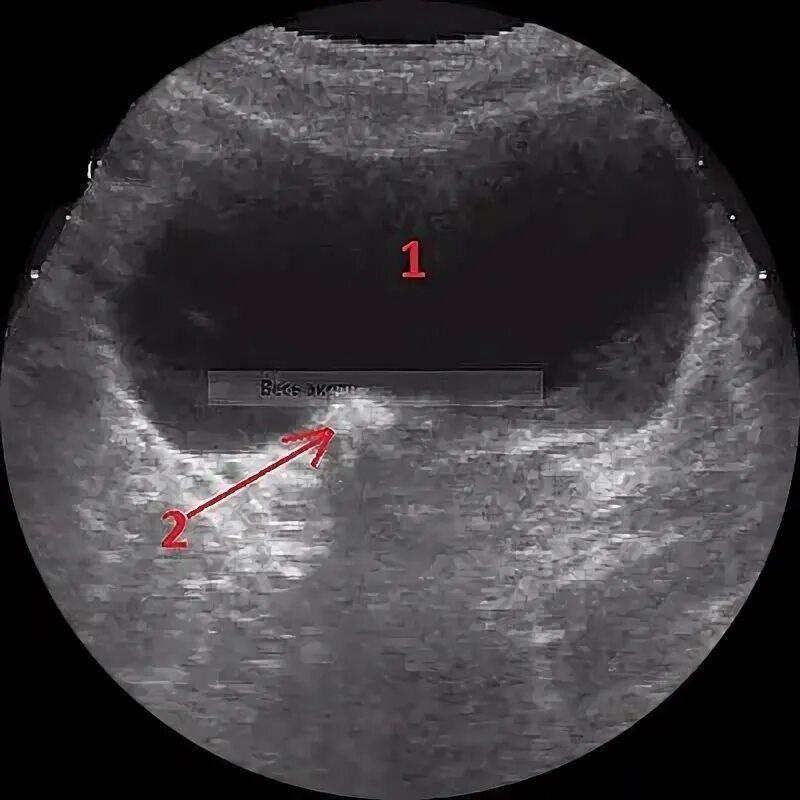 Интрамуральный мочеточник. Камень в Устье мочеточника 5 мм. УЗИ мочевого пузыря Устье мочеточника. Уретероцеле мочеточника УЗИ. Камень устья мочеточника на УЗИ.