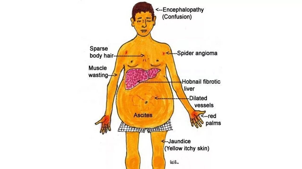 Лицо больного печени. Симптомы и стадии цирроза печени алкогольного. Опорные клинические признаки цирроза печени. Цирроз печени внешность человека.