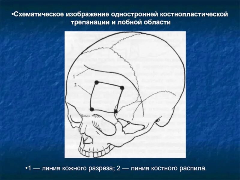 Костно-пластическая Трепанация черепа по Оливекрону. Трепанация черепа лобной кости. Костно-пластическая Трепанация краниофиксы кт. Костнопластическая Трепанация разрез.