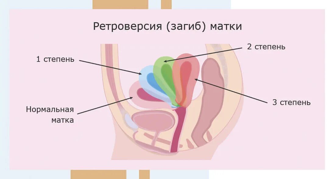 Загиб матки. Ретроверсия матки. Изгиб матки. Загиб шейки матки. Изгиб шейки