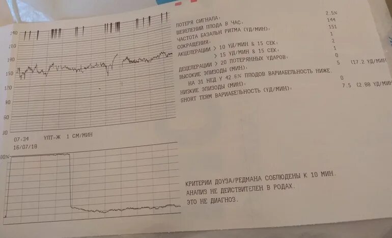 Шевеление плода 32 неделя. КТГ плода на 32 неделе беременности. Норма шевелений плода на КТГ. Норма шевелений плода на КТГ 32 недели. КТГ при беременности шевеления плода норма.