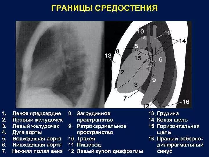 Средостение рентген анатомия. Средостение рентген анатомия кт. Образования верхнего средостения на рентгенограммах. Образование переднего средостения рентген. Нижняя граница левого легкого