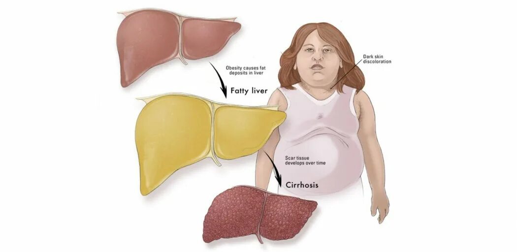 Повышенная печень что означает. Как выглядит печень человека. Как выглядит увеличенная печень.