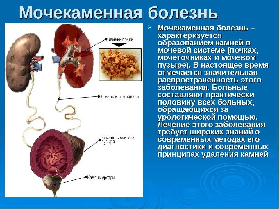 Почки научная статья. Заболевания мочевыделительной системы мочекаменная болезнь. Мочекаменная болезнь патанатомия. Почечнокаменная болезнь механизмы образования почечных камней. При мочекаменной болезни конкременты образуются в.