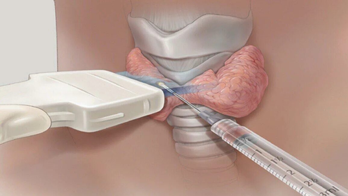 Почему делают биопсию. Тонкоигольная аспирационная биопсия. Трепанобиопсия щитовидной железы. Тонкоигольная аспирационная биопсия (таб). Тонкоигольная аспирационная биопсия узла щитовидной железы.