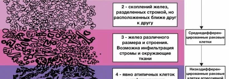 градация глисона. классификация глиссона. шкала глиссона.