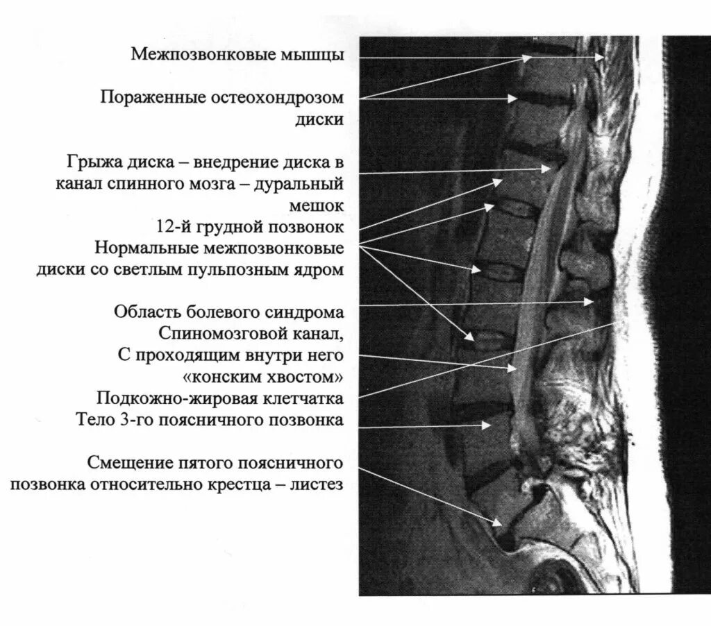 Что такое дуральный мешок шейного отдела позвоночника. Протрузия диска компримирующая дуральный мешок. Дуральный мешок позвоночника строение. Что такое дуральный мешок в шейном отделе позвоночника. Дуральный мешок позвоночника компремирован.