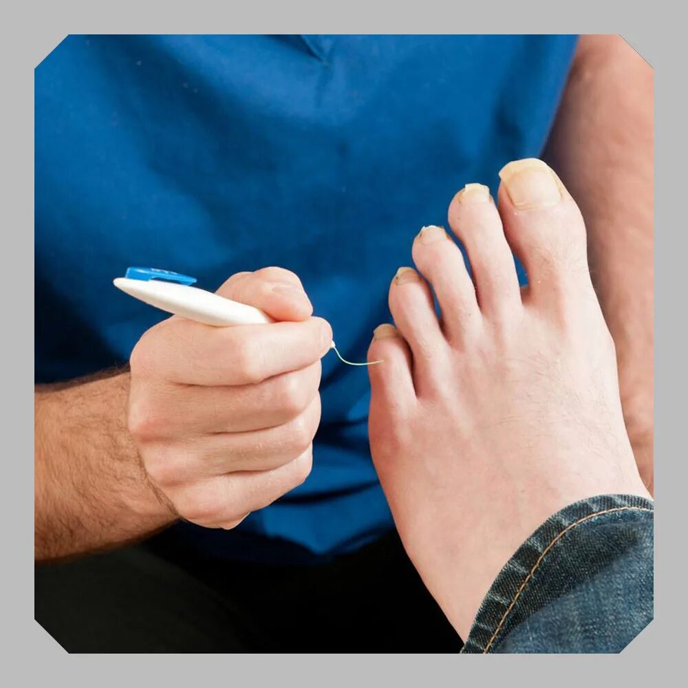 Борьба на пальцах ног. Сахарный диабет ногти на ногах.