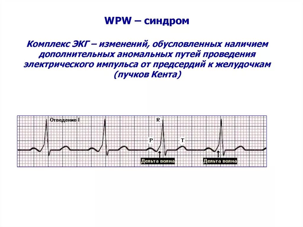 Wpw синдром ЭКГ. Wolff Parkinson White (wpw) синдром. Синдром ВПВ сердца на ЭКГ. ВПВ синдром на ЭКГ признаки.