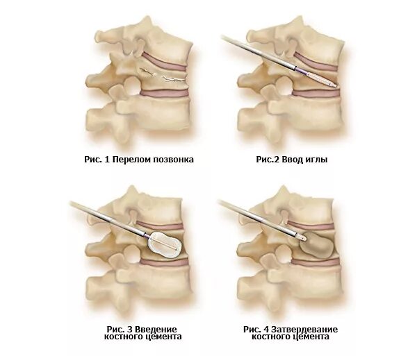 Лечение последствия компрессионного перелома позвоночника. Компрессионный перелом вертебропластика. Компрессионный перелом позвоночника th-5-6. Компрессионный перелом 7 позвонка 1 степени. Компрессионный перелом 1 грудного позвонка.