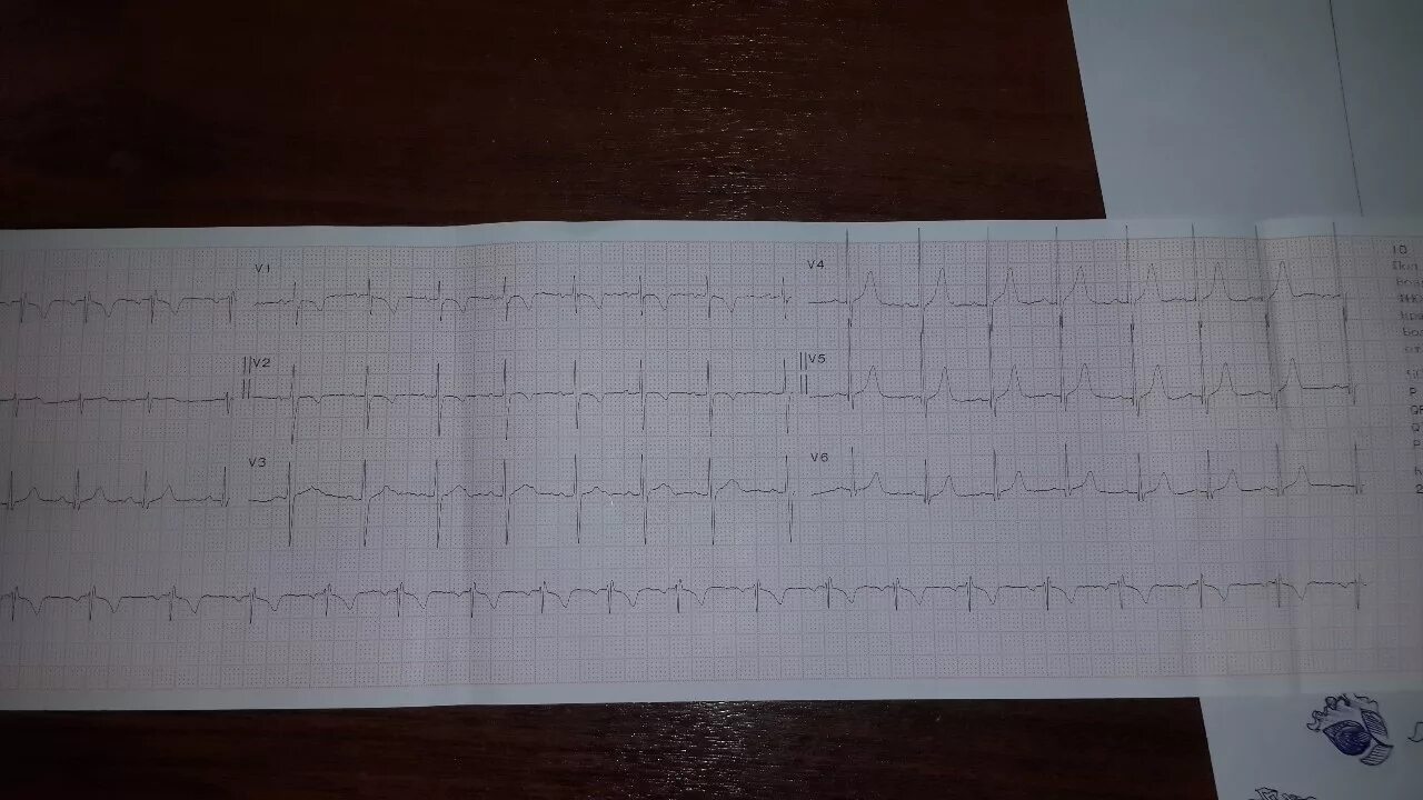 Экг ребенку 7 лет. Лежа ЭКГ У ребенка 7 лет норма. ЭКГ ребенка 6 лет норма фото. ЭКГ У детей нижняя стенка. Кардиограммы грудничку 7 месяцев.