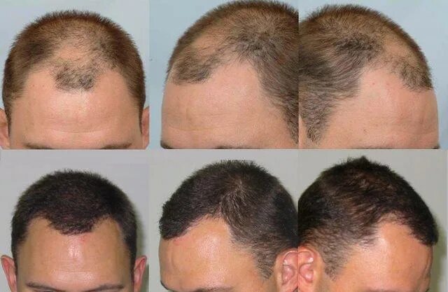 Пересадка волос цена для мужчин 2024. Трансплантация волос fue.