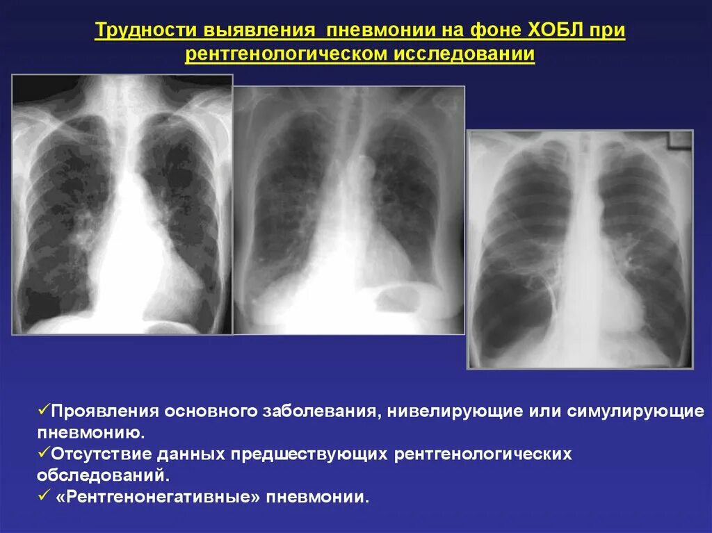 Лучевые заболевания легких. Крупозная пневмония рентгенограмма. Пневмония на рентгене. Снимок при пневмонии.