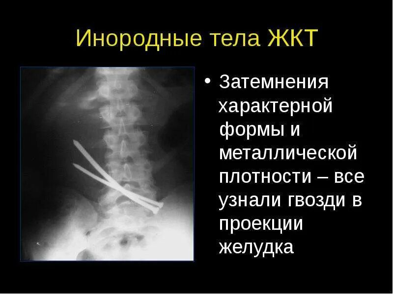 Инородный предмет в теле. Инородные тела желудочного тракта. Инородное тело в желудке у ребенка. Инородные тела желудочного тракта. Инородные тела желудочного тракта.