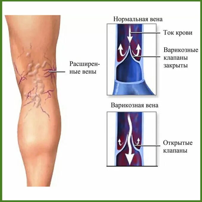 Варикозное расширение вен. Варикозное расширение вен нижних. Вены ног клапаны