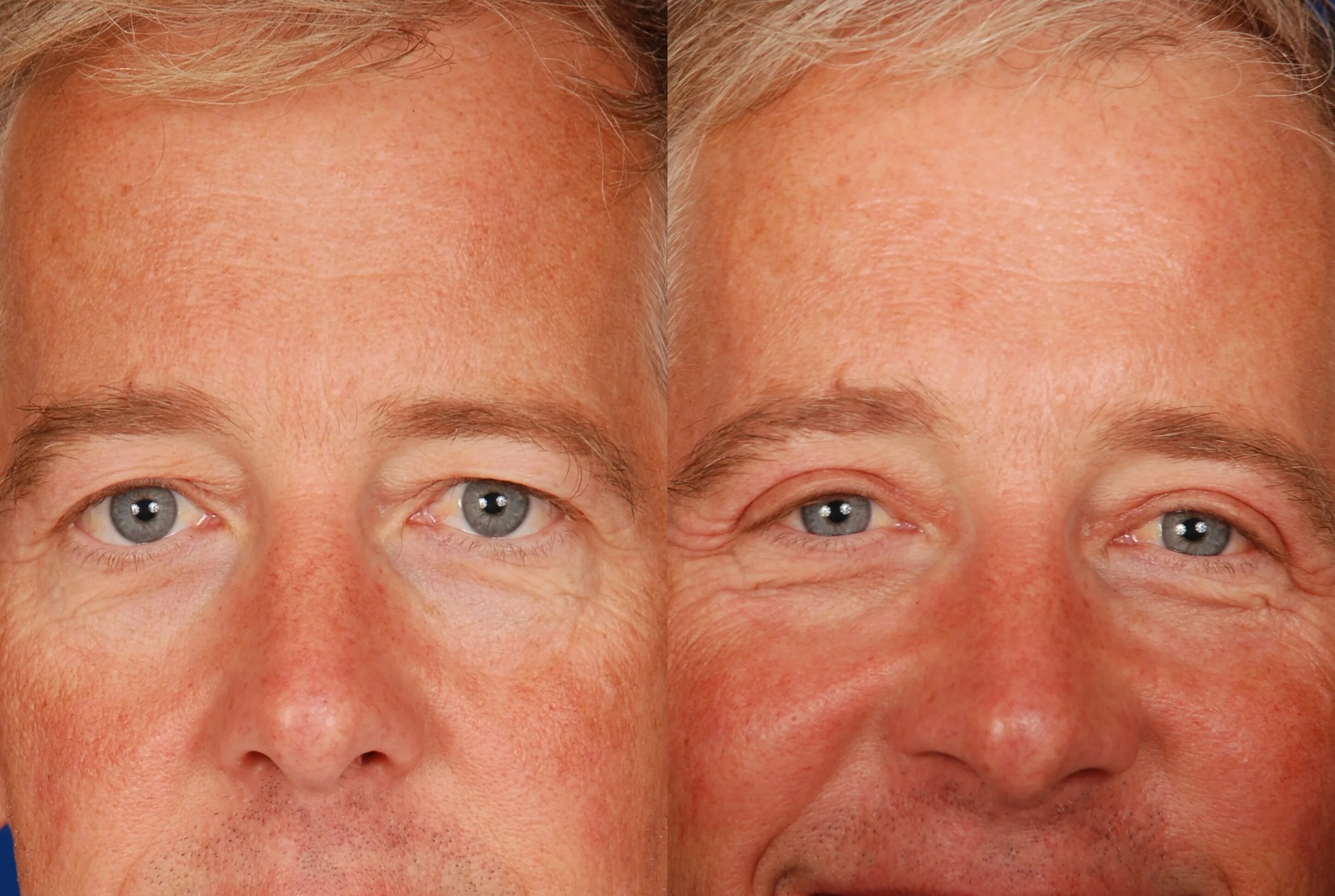 Blepharoplasty.