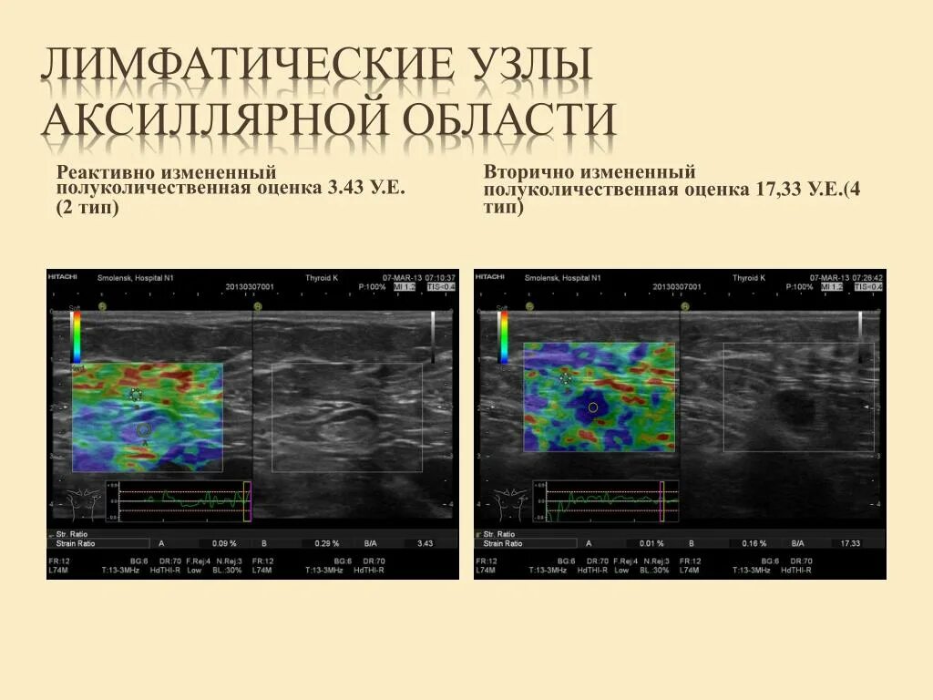 Эластография молочной железы протокол УЗИ. Эластография щитовидной железы протокол УЗИ. Компрессионная эластография печени. Эластография щитовидной железы протокол. Норма аксиллярных лимфоузлов