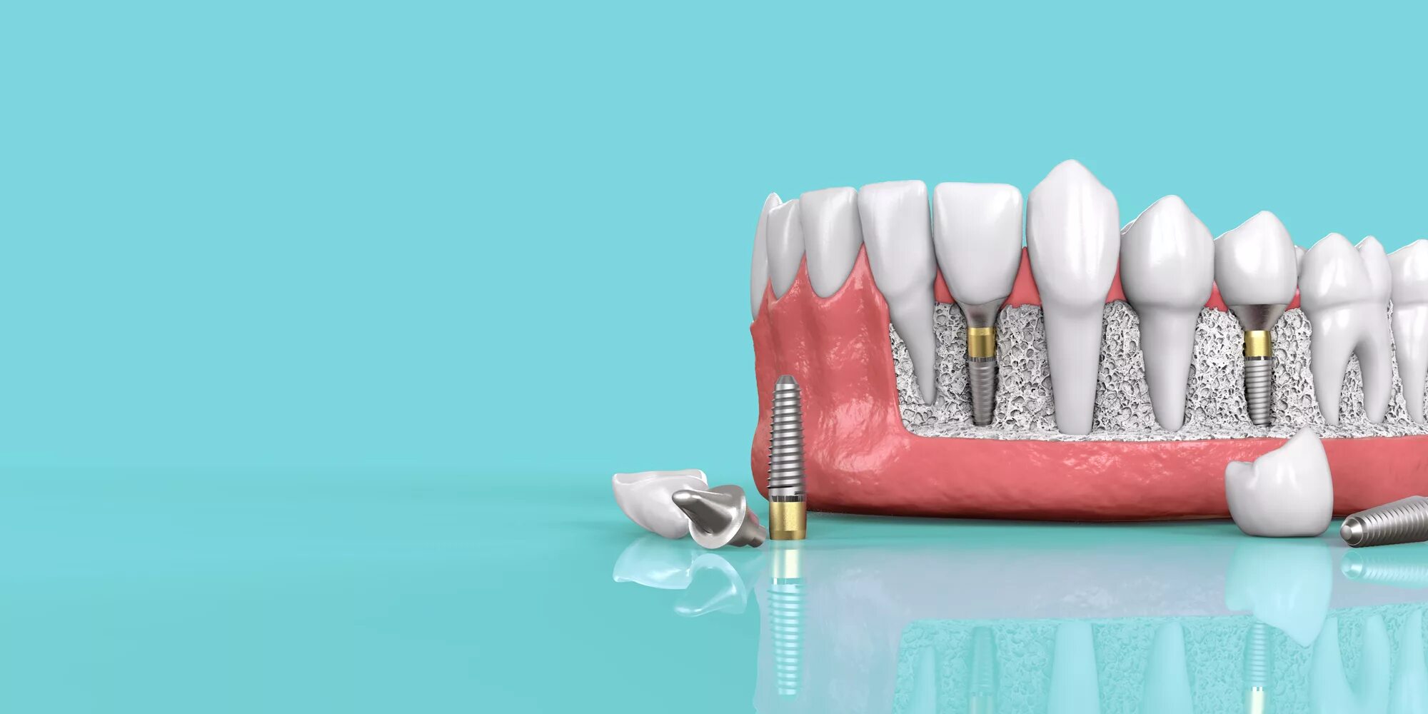 Зуба без рекламы. Зубной имплант dentis. Имплантаты Dentium Superline. Зубные имплантаты Straumann. Креативная реклама стоматологии.