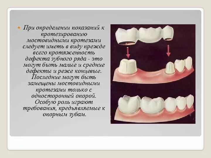 Противопоказания к изготовлению коронки. Консольные мостовидные протезы консоль. Металлокерамические мостовидные протезы показания. Съемный мостовидный протез показания. Мостовидные протезы с односторонней опорой.