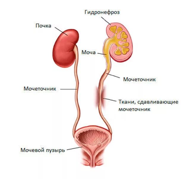 Как выглядит мочеточник