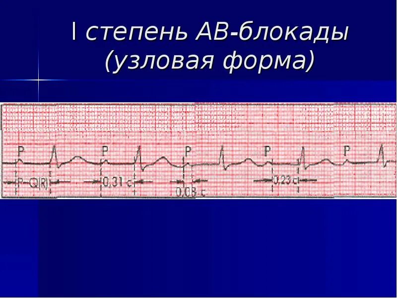 Блокада на первом. АВ блокада 1 степени Узловая форма на ЭКГ. АВ Узловая блокада на ЭКГ. Узловая форма av блокады 1 степени. Проксимальная форма АВ блокады 3.