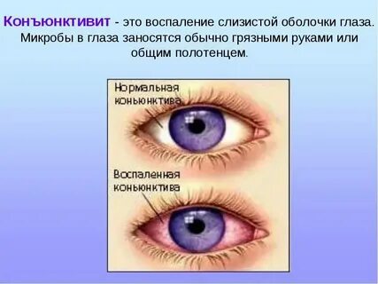 Конъюнктивит взрослый сколько дней