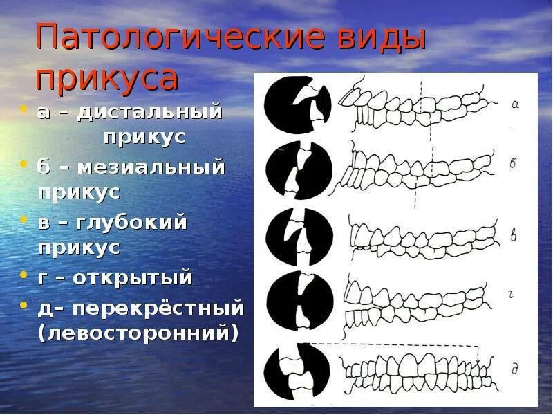 Прикус виды окклюзий. Прикус виды окклюзий. Прикус виды окклюзий. Прикус виды окклюзий. Прикус прогнатия и прогения.