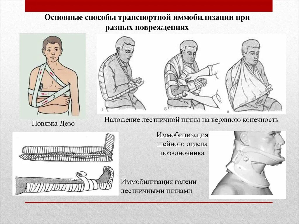 Шина при травме головы. Иммобилизация при переломе шейного отдела позвоночника шина Крамера. Наложение транспортной шины при переломе шейного отдела. Наложение шины Крамера при переломе шейного отдела. Шина Крамера при переломе шейного отдела.