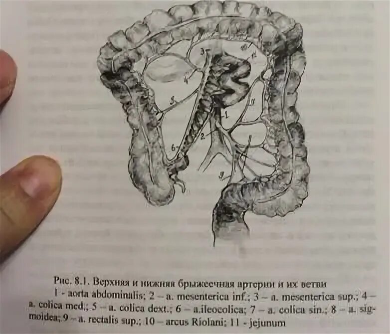 Верхняя и нижняя брыжеечные артерии. Тромбоз верхней брыжеечной артерии. Верхняя брыжеечная и нижняя брыжеечная артерия. Верхняя брыжеечная артерия кт. Мезентериальный тромбоз мкб 10