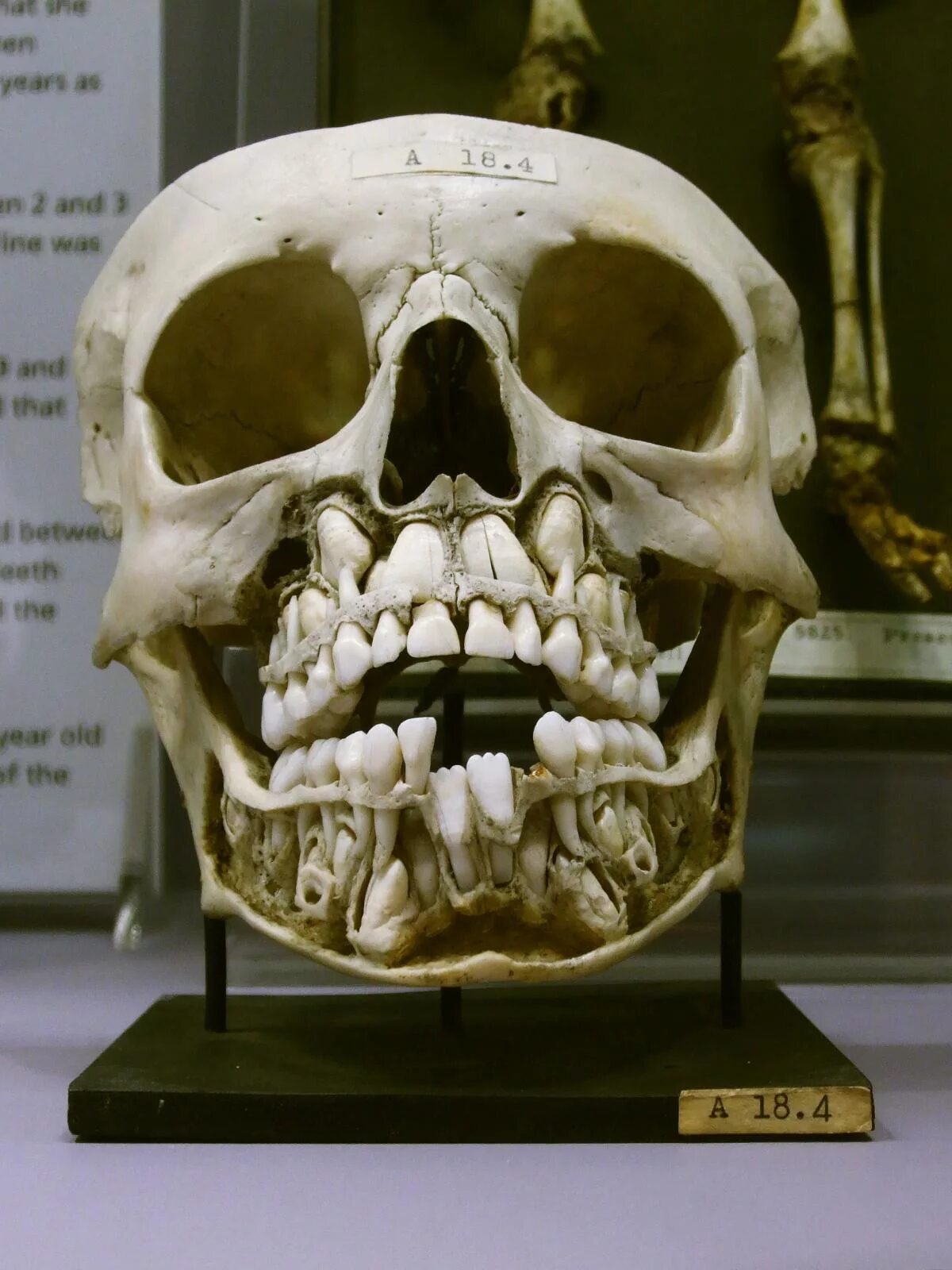 Детский череп фото. Рентген черепа ребенка коренные зубы. Рентген черепа с молочными зубами.