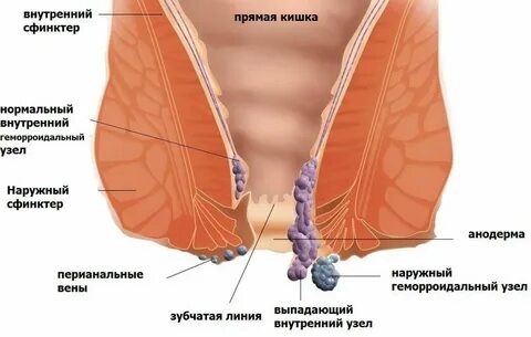 Лечение геморроя 