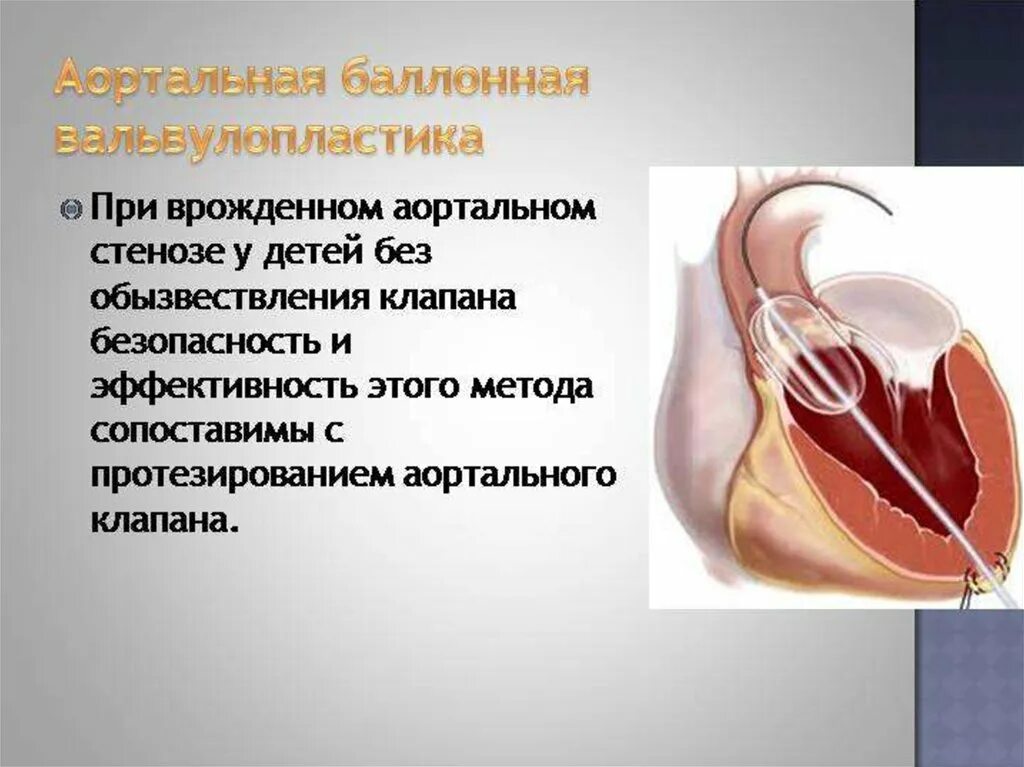 Аортальный стеноз что это такое. Чрескожная вальвулопластика. Транскатетерная баллонная вальвулопластика. Чрескожная баллонная митральная вальвулопластика. Баллонная аортальная вальвулопластика.