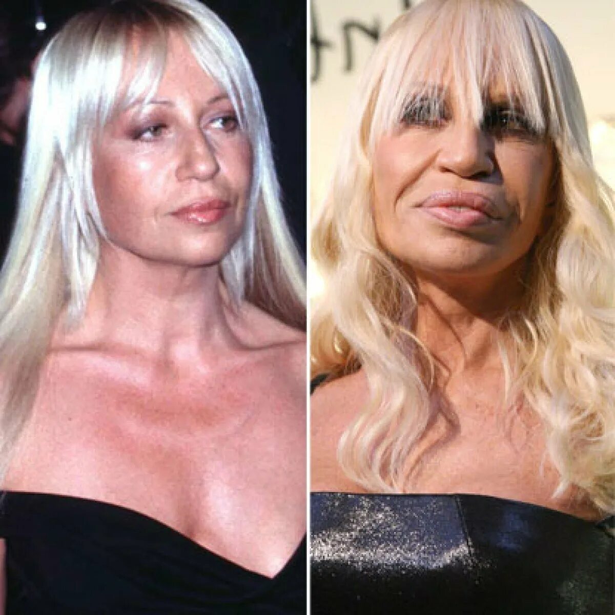 Донателла Версаче в молодости. Donatella Versace до пластики. Донателла Версаче до и после пластических операций. Донателла Версаче пластика.