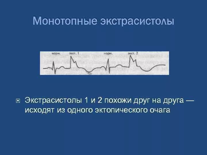 ЭКГ монотопные желудочковые экстрасистолы. Монотопная желудочковая экстрасистолия. Полиморфная экстрасистолия. Монотопные мономорфные экстрасистолы. Политопные экстрасистолы