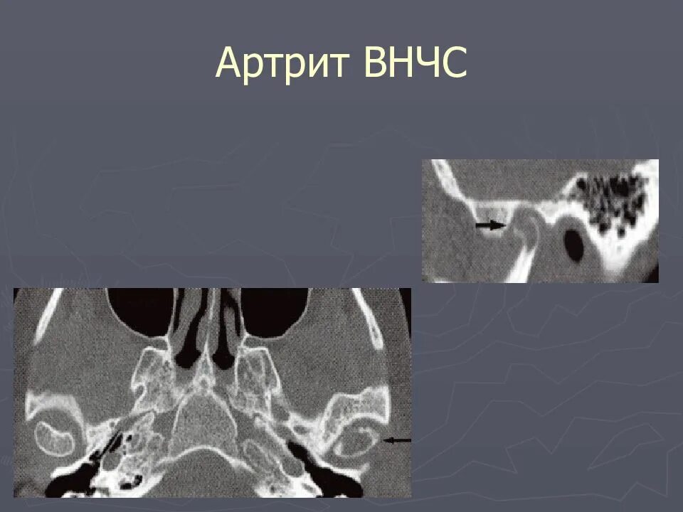 Артрит кт. Острый травматический артрит ВНЧС. Ревматоидный артрит ВНЧС рентген. Ревматоидный артрит ВНЧС кт.