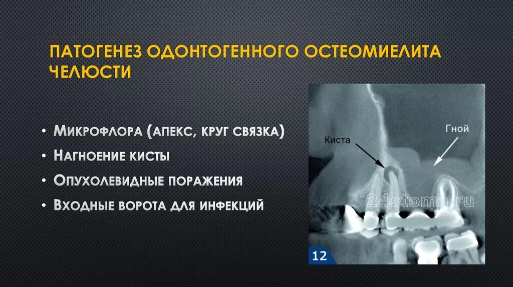 Одонтогенный процесс. Остеомиелит кости зубов. остеомиелит зуба рентген. этиология остеомиелита челюсти. острый одонтогенный остеомиелит.