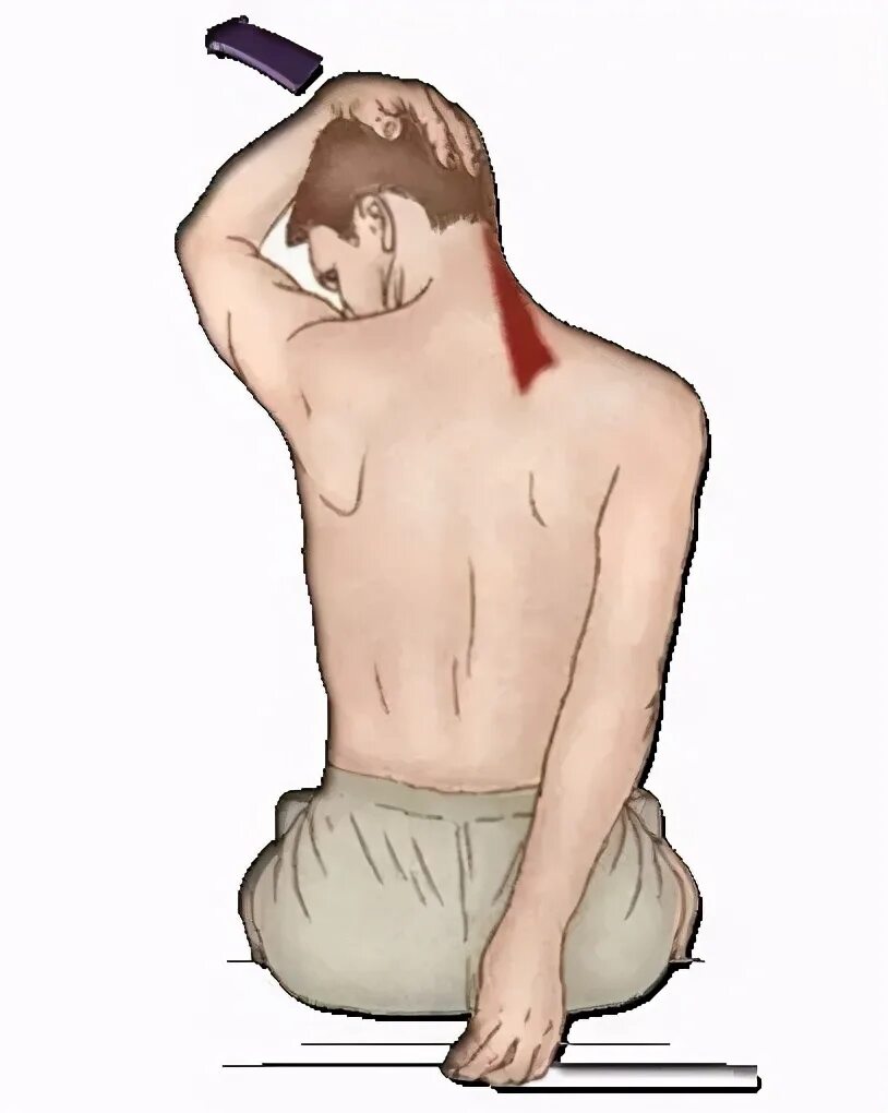 Лопатка поднята вверх