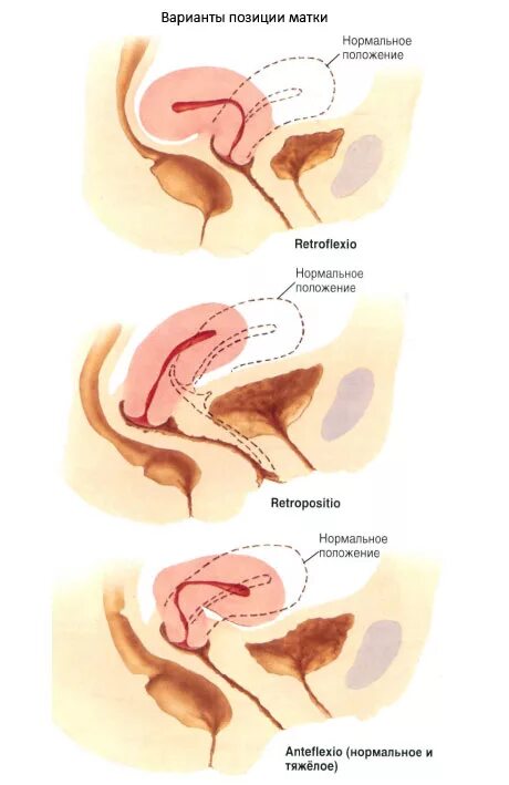 Загиб матки кзади анатомия. Расположение матки anteflexio. Anteflexio матка при беременности. Антефлексио положение матки что это. Изгиб шейки