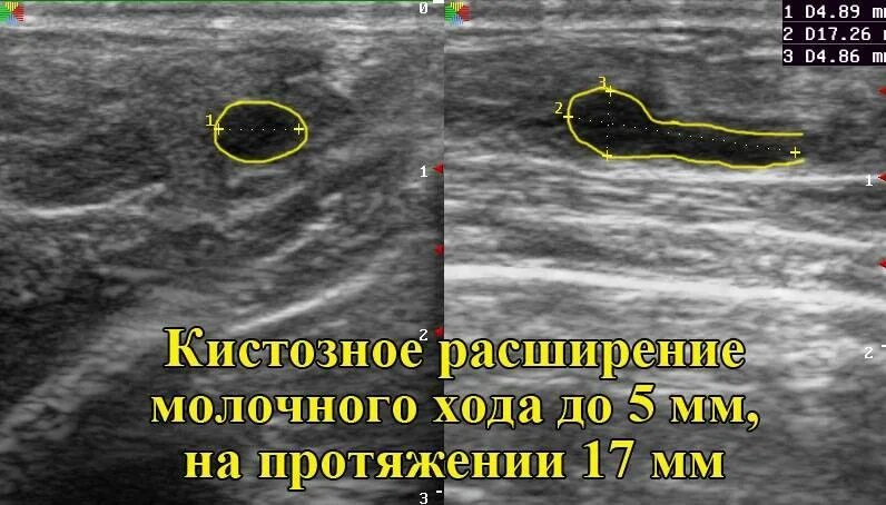 Дуктэктазия молочной. Дуктэктазия молочной железы на узи. расширенные протоки молочной железы на узи. расширение протока молочной железы на узи. расширение протоков молочной железы на узи.
