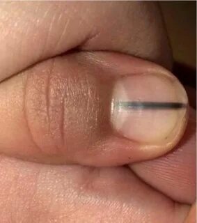 Пластина на ноготь на руке
