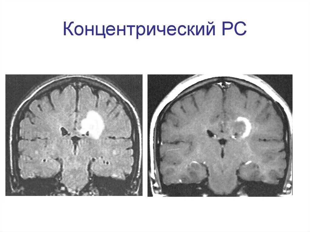 Склероз мозга. Рассеянный склероз головного мозга. Поражение ствола головного мозга при рассеянном склерозе. Поражение белого вещества головного мозга. Рассеянный склероз в белом веществе.