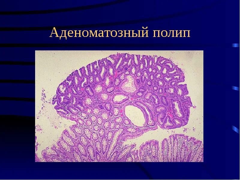 Диффузный семейный полипоз