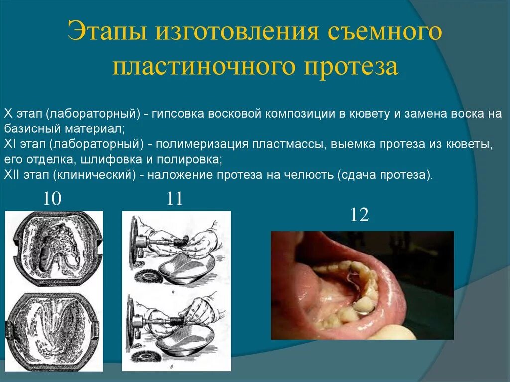 Клинико лабораторные этапы съемных пластиночных протезов. Лабораторные этапы изготовления протезов. Съемный пластиночный протез клинико лабораторные этапы. Лабораторные этапы изготовления съемных пластиночных протезов. Клинические этапы изготовления съемных протезов.