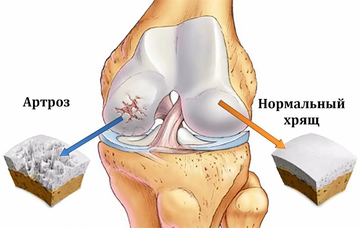 Акулий хрящ капсулы китай. Акулий жир для суставов капсулы. Акулий жир для суставов акулий хрящ. Продукты для питания больных суставов. Хрящ жир.