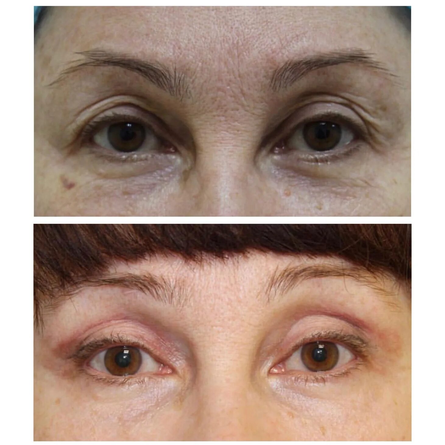 блефаропластика сочи отзывы. суслов киров блефаропластика. трансконъюктивальная блефаропластика нижних век. круговая блефаропластика. татьяна германовна блефаропластика.